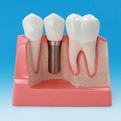Zubn implantty